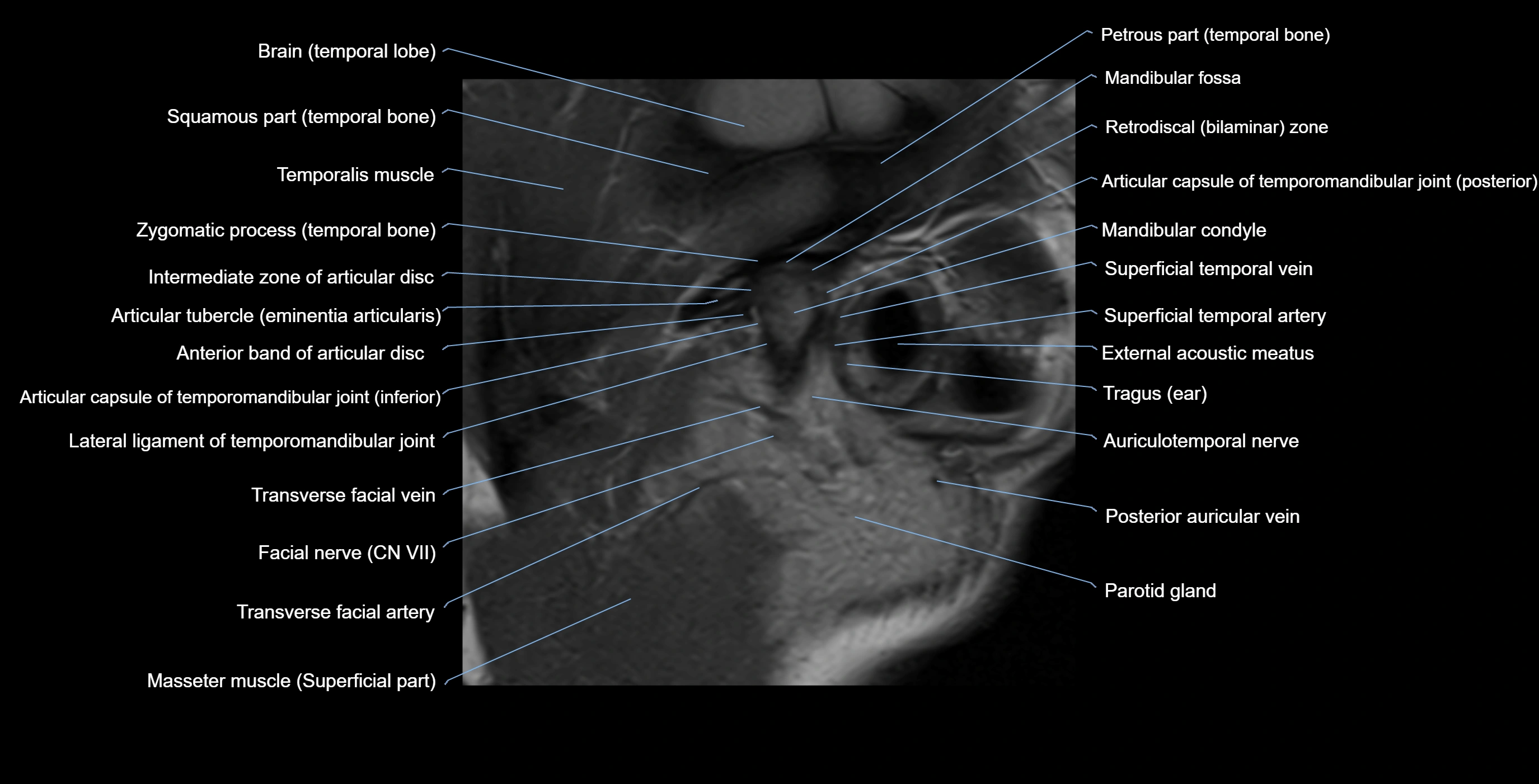 MRI TMJ sagittalclosed  mouth cross sectional 3T anatomy -img-00001-00005.webp